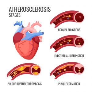 Atherosclerosis stages. Normal functions, endothelia disfunction, plaque formation, plaque rupture thrombosis. Arteriosclerotic vascular disease or ASVD, artery-wall thickens - Forest Medical Device Testing